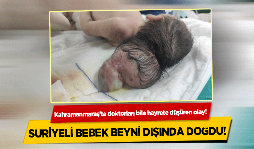Kahramanmaraş’ta doktorları bile hayrete düşüren olay! Suriyeli bebek beyni dışında doğdu!